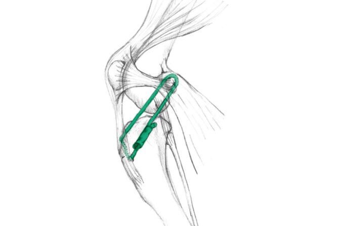 'Lateral Suture'-techniek bij een gescheurde kruisband